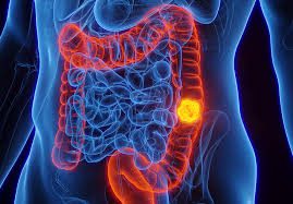 Leia mais sobre o artigo Estudo do IESS identifica crescimento de 80,3% de casos de câncer colorretal no Brasil em 8 anos